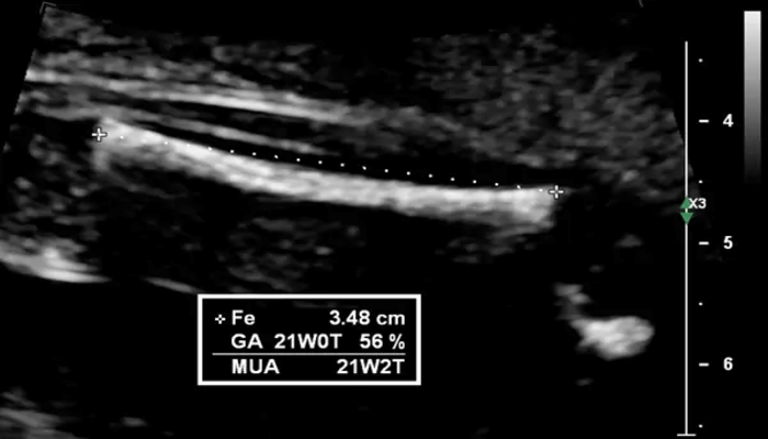 Hình ảnh siêu âm chiều dài xương đùi thai nhi xem thai nhi có đang phát triển bình thường hay không 