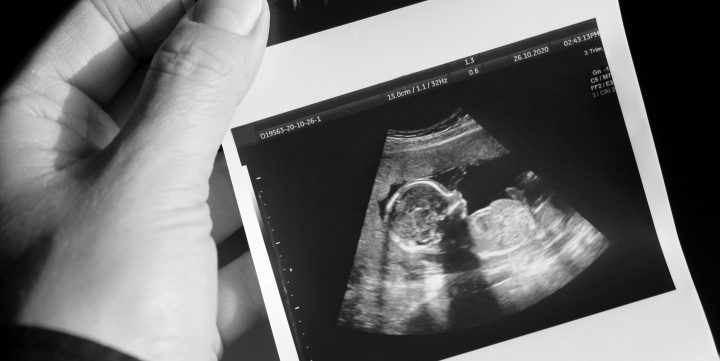 Phần màu trắng là da của bé còn phần màu đen là dịch tích tụ sau gáy