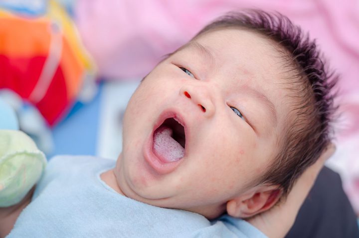 Nấm miệng ở trẻ sơ sinh